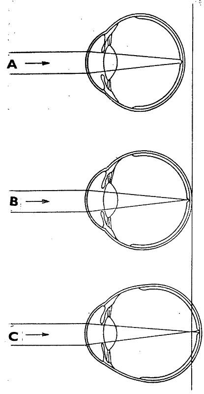 Obr. 8: Dioptrické zrakové vady. A - krátkozraké oko (obraz vzniká před sítnicí); B - normální oko (obraz vzniká na sítnici); C - dalekozraké oko (obraz vzniká za sítnicí).